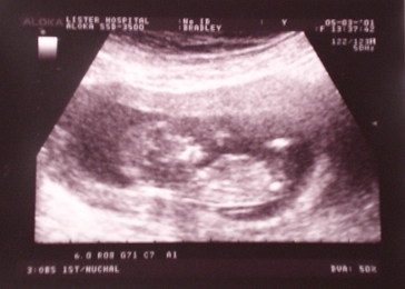 12 week scan